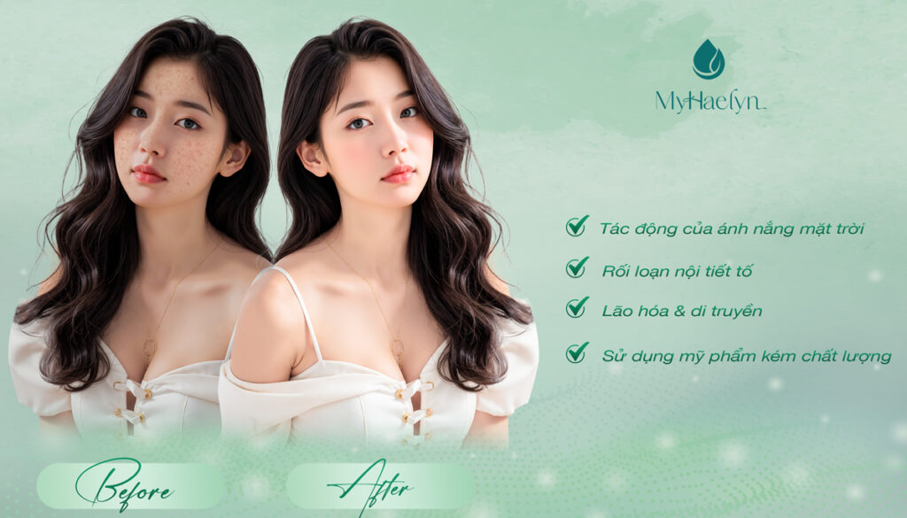 Nguyên nhân gây nám, tàn nhang và sạm da