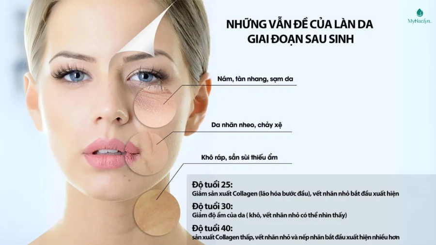 Vấn đề về làn da của các mẹ trong giai đoạn sau sinh