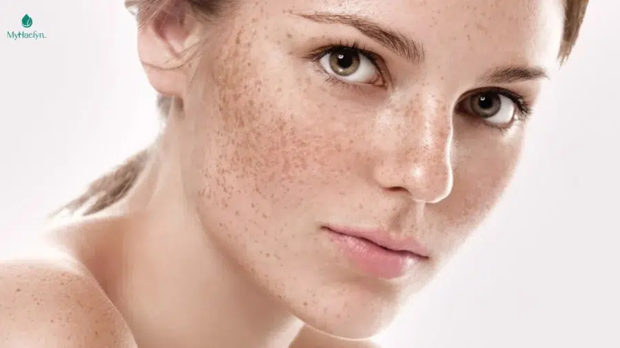Viên uống trị nám chuyên biệt hướng tới việc cân bằng hormone