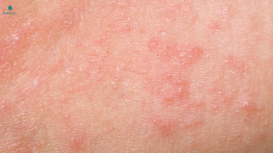 Không kiểm tra phản ứng da trước khi dùng dễ gây kích ứng cho làn da