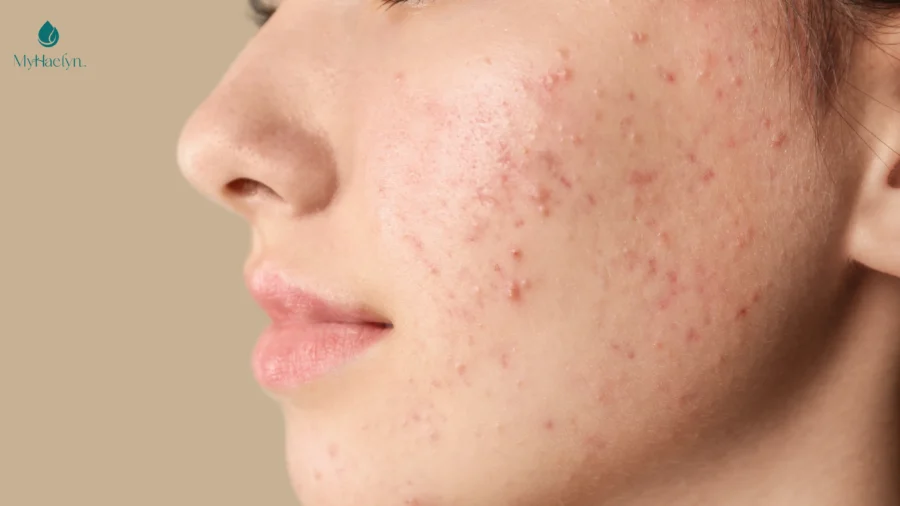 Da mụn nên sử dụng serum B5 để làm dịu da và phục hồi tổn thương