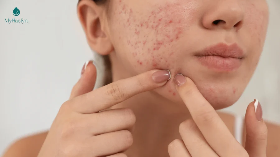 Làn da tuổi dậy thường nhạy cảm do thay đổi nội tiết tố