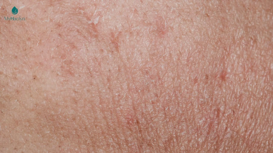 Lạm dụng collagen nano khiến da mất đi độ đàn hồi tự nhiên