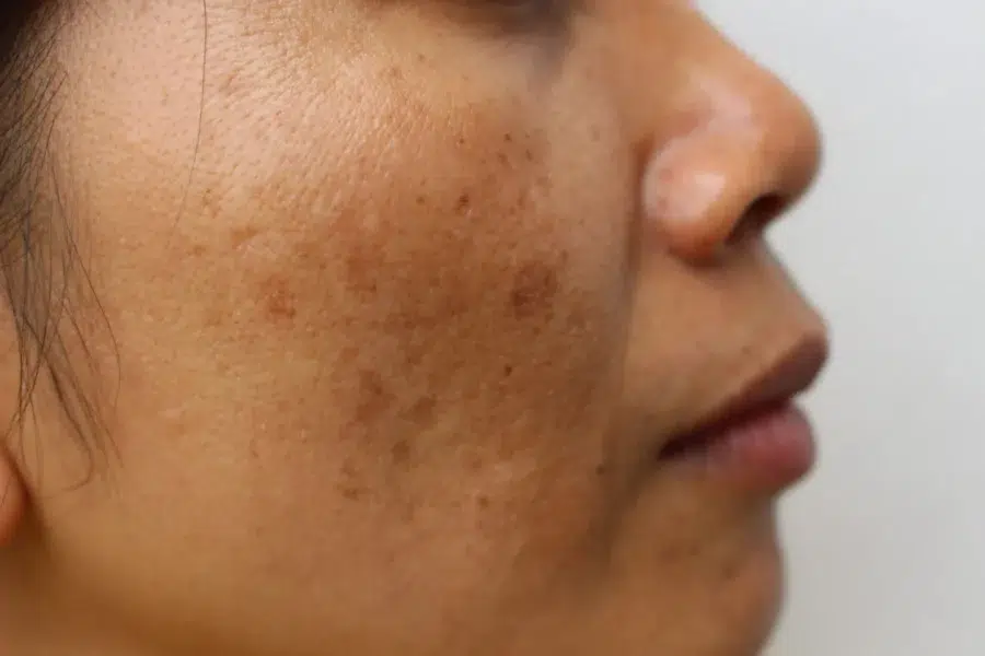 Da Bị Đen Sạm Và Xuống Tone Nhanh